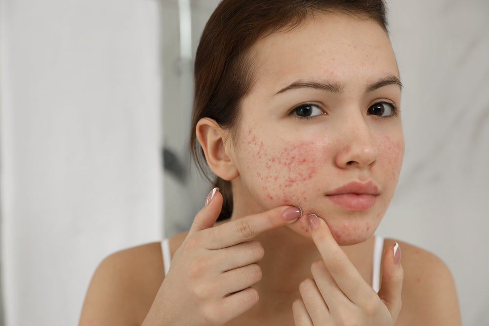 Relief from Acne